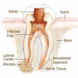 root canal wellington