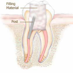 wellington root canal